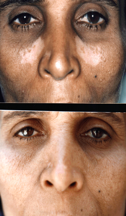 vitiligo face