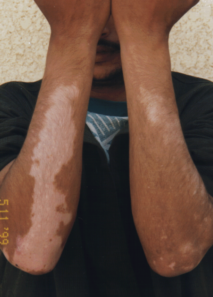 forearm lesions